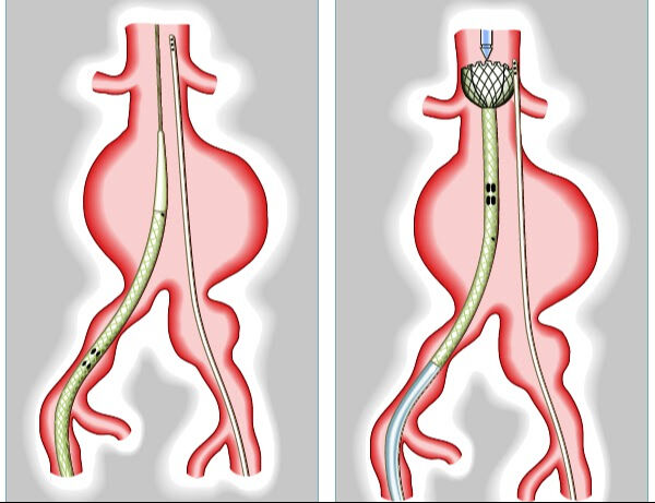 Aort Damarı Yırtılması Tedavisi