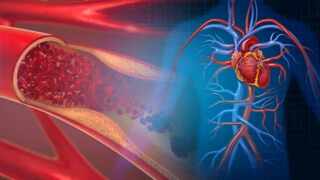 Aort Damarı Yırtılması Tedavisi