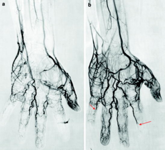 Buerger Hastalığı Tedavisi