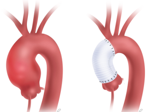 cikan-aort-anevrizmasi