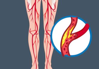 periferik arter hastalığı